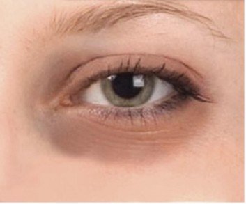 How To Remove Dark Circles Around Eyez